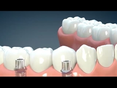 Custom Made Dental Lab Products Polymer Removable Partial Dentures