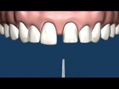 Resistenza della corrosione della protesi dentaria del collegamento di precisione del CR MK1 di CO