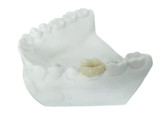 Parte sovrapposto in rilievo dentario Tutto ceramico durevole dell'intarsio dell'impiallacciatura della corona di FDA simile