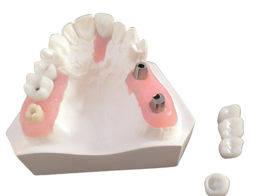 FDA Corona di zirconio con protesi dentarie a supporto di impianto per laboratorio dentale
