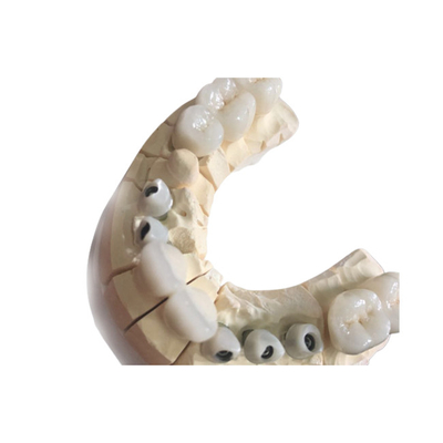 Biocompatibilità eccellente delle corone dentarie bianche libere di biossido di zirconio del metallo