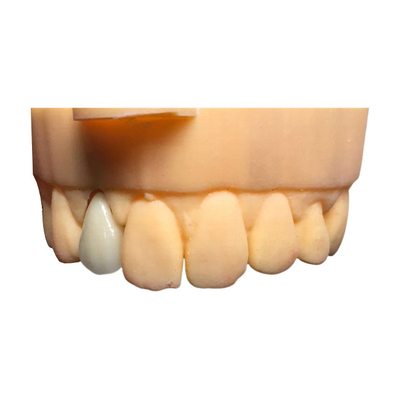 Biocompatibilità del ponte dentario della corona di sicurezza PFM di Chromecast buona