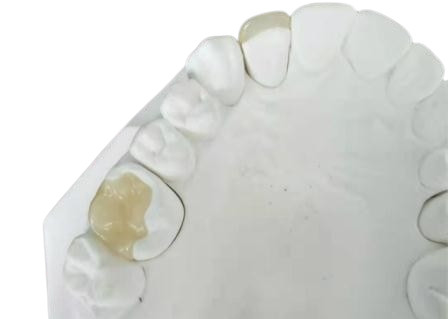 Corona flessibile durevole IPS dentario E Max Press Inlay Onlay del ponte di PFM