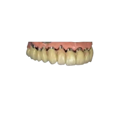 La corona telescopica 3D dentario del ponte della corona dell'impianto di camma PFM di cad ha stampato i modelli