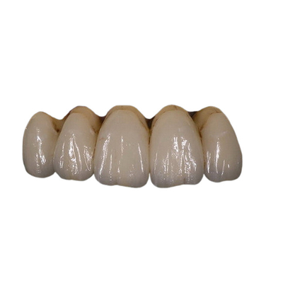 Facile mantenga la stabilità di colore dentaria della corona della porcellana ortodontica di PFM