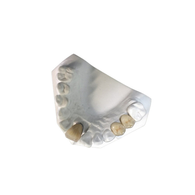 Il dente naturale dell'alta corona dentaria ceramica della stabilità PFM macchia resistente