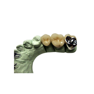 Alta porcellana della corona di biocompatibilità PFM fusa per ripristino dei denti posteriori
