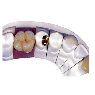 Corona dentaria della porcellana di PFM