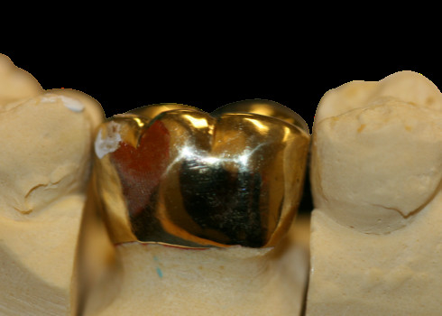 Laboratorio dentario di protezione FMC del ponte fine ad alta densità della corona