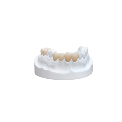 Impiallacciatura della corona dentaria ceramica dei parti sovrapposti in rilievo degli intarsi forte per il dipartimento dentario