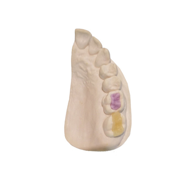Corona Tutto ceramica di FDA della ceramica dentaria su ordinazione ad alta densità su ordinazione