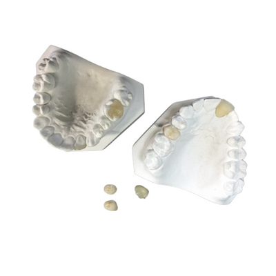 Facile mantenga il parte sovrapposto in rilievo dentario ceramico bianco dell'intarsio dell'impiallacciatura della corona dell'OEM