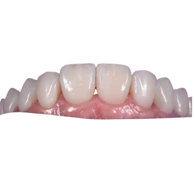 Corona dentaria ceramica d'imbiancatura di 0.3MM per sostituire i denti non sani