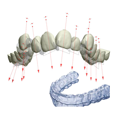 Il fermo rinforza FDA ha riparato l'apparecchio ortodontico con 3D
