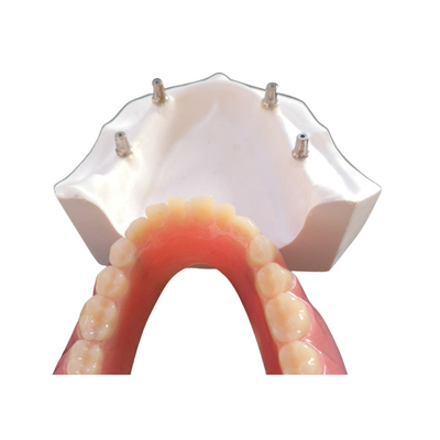 L'impianto dentario comodo Overdenture di camma di cad facile mantiene