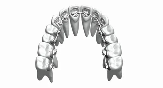I ganci ortodontici fissi degli apparecchi di abitudine raddrizzano l'acciaio inossidabile Bioceramic dei denti