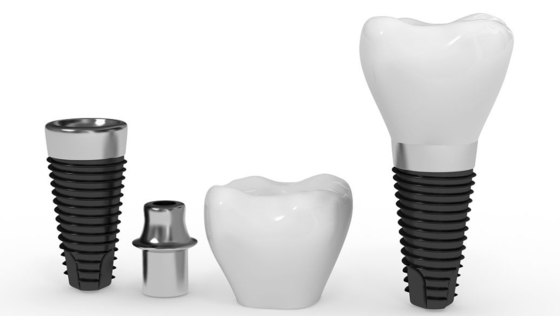Impianto dentario naturale lungo Antivari di tempo di impiego dell'impianto artificiale affidabile sicuro della radice