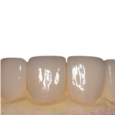 I denti lisci della porcellana non impiallaccia belle impiallacciature bianche della porcellana di irritazione