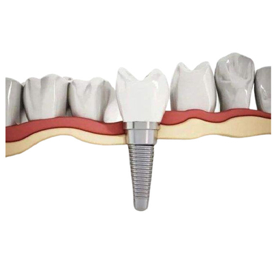 Alta biocompatibilità di titanio durevole dell'impianto dentario resistente alla corrosione