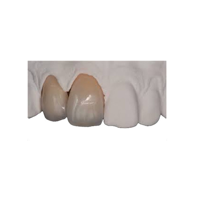 Ripristino realistico naturale durevole della corona sottile di biossido di zirconio di forza del corpo