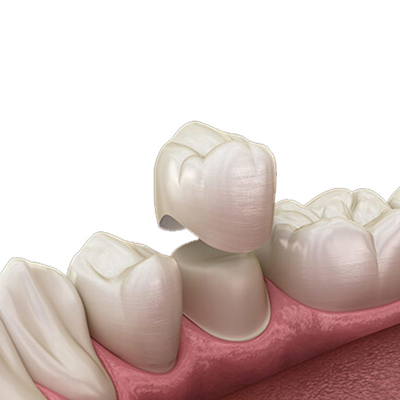 Trattamento duro resistente di biossido di zirconio dell'OEM della crepa unica dentaria naturale della corona