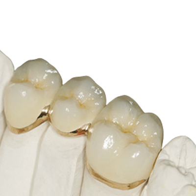 Corona temporanea non irritante della resina con la buona biocompatibilità