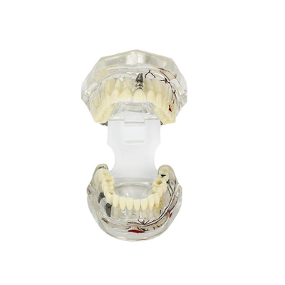 Modello di dente patologico trasparente dentale con personalizzazione del nervo del dente