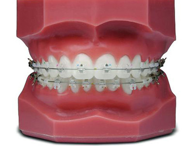 Comodi apparecchi ortodontici fissi Bellissimi bracket in ceramica naturale