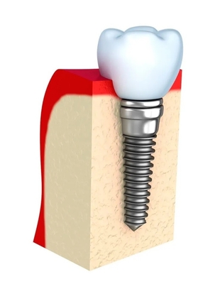 Protesi dentarie Temporanee Impianto dentale Barra Singola Tutti i denti in ceramica