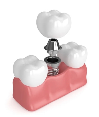 True Dentures Impianti Singoli Tutte le protesi in ceramica Otturazioni dei denti mancanti