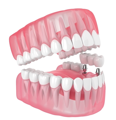 Singolo Tutti i denti in ceramica Impianti dentali Mancante Riempimento Protesi Denti del giudizio