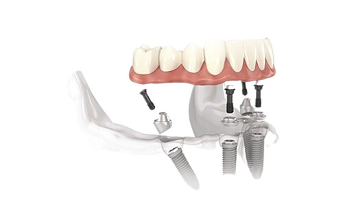 Protesi rimovibili invisibili Impianti riempiti Restauro completo Overdenture