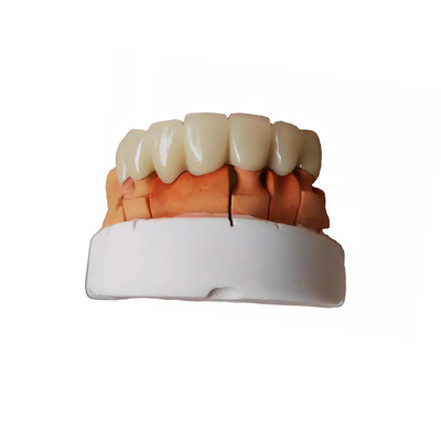 Garanzia della qualità di superficie regolare della corona dentaria temporanea di PFM