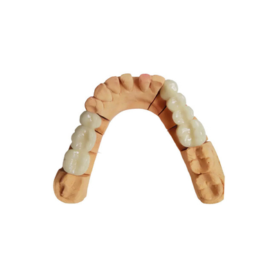 Colore stabile Corona dentale PFM Resistenza agli acidi e agli alcali Non facile da indossare