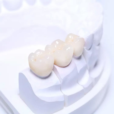 Garanzia della qualità dentaria parziale smontabile di superficie regolare del ponte delle protesi dentarie PFM
