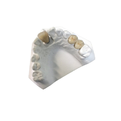 Stato ad alta resistenza dell'OEM della corona dentaria della porcellana dell'oro giallo nuovo