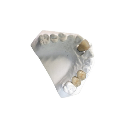 Corona ceramica ad alta resistenza del laboratorio dentario PFM della corona della porcellana dell'oro giallo