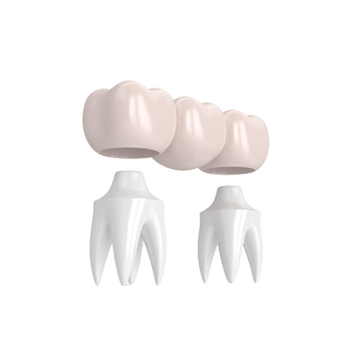 Ponti realistici di aspetto e colore naturale stabilità dentaria delle corone di forte