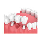 La forte resistenza all'usura dentaria comoda dei ponti e delle corone rende il sorriso più dolce