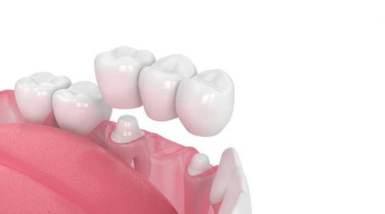 Buona forza del morso di stabilità della corona di aspetto realistico dentario ad alta resistenza del ponte