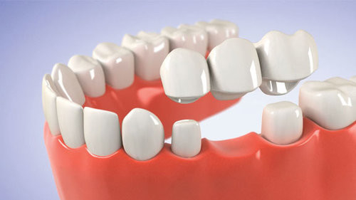Buona forza del morso di stabilità della corona di aspetto realistico dentario ad alta resistenza del ponte