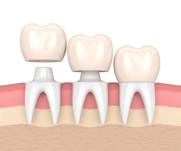 Stalla non facile da indossare dentaria di colore delle corone e dei ponti di buona biocompatibilità