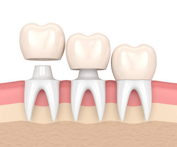 Le bei corone e ponti dentari lisciano la superficie per la sicurezza di igiene orale