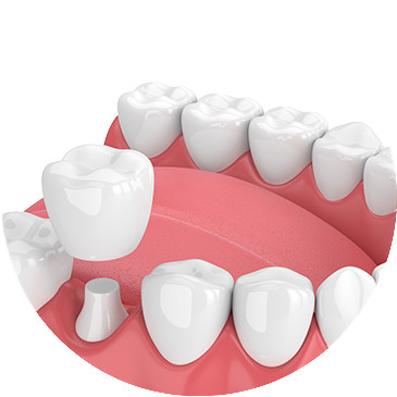 Le bei corone e ponti dentari lisciano la superficie per la sicurezza di igiene orale