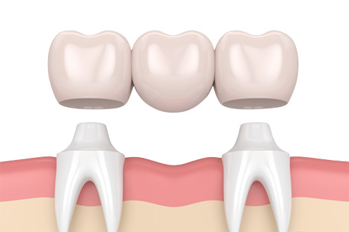 Rivestimento di resistenza all'usura della corona del dente della porcellana di sicurezza di igiene orale alto alto