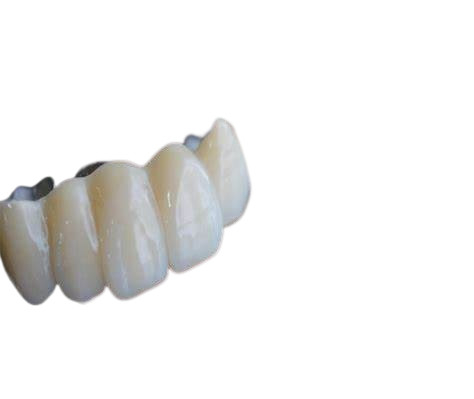 Ponti realistici di aspetto e colore naturale stabilità dentaria delle corone di forte