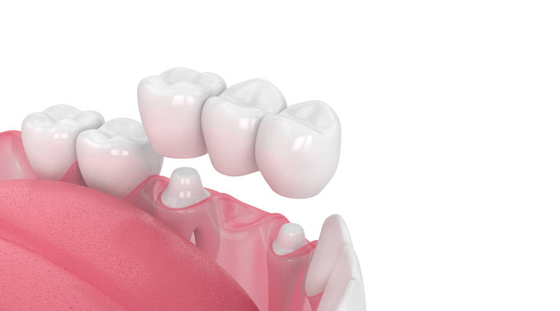Biocompatibilità dentaria di resistenza dell'acido e dell'alcali della corona della porcellana buona