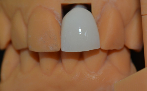Ridefinendo estetica il nostro Natura che sembra le corone dell'impianto dentario