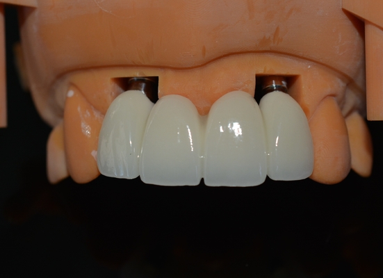 Precise CAD/CAM Design Zirconia Corona dentale per l'adattamento
