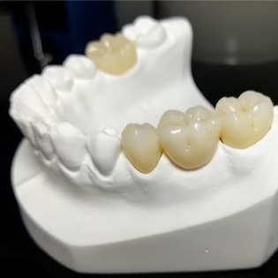 Qualità costante le corone di Mark Of Our Ceramic Dental